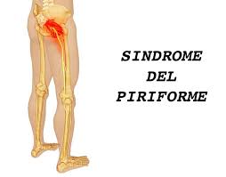 Sciatalgia o sindrome del piriforme